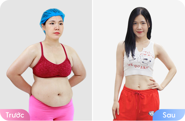 Giảm béo cấu trúc đa công nghệ