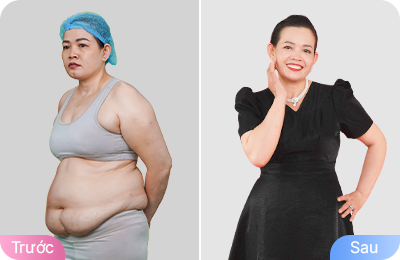 Giảm béo cấu trúc đa công nghệ