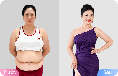 Giảm béo cấu trúc đa công nghệ