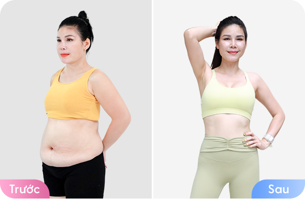 Giảm béo cấu trúc đa công nghệ