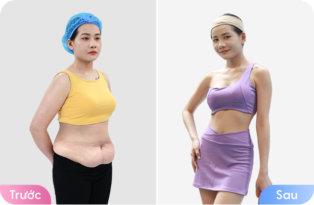 Giảm béo cấu trúc đa công nghệ