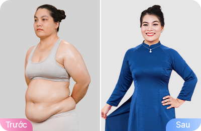 Giảm béo cấu trúc đa công nghệ