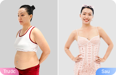 Giảm béo cấu trúc đa công nghệ