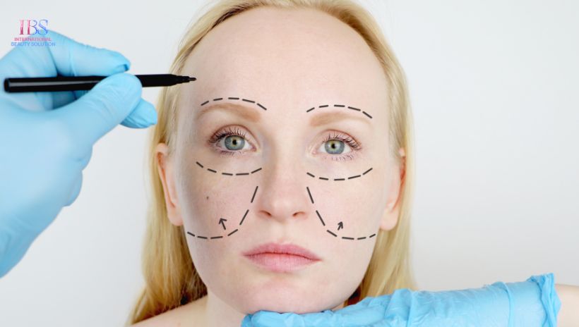 Ai Nên Căng Da Mặt Bằng Chỉ Gai?