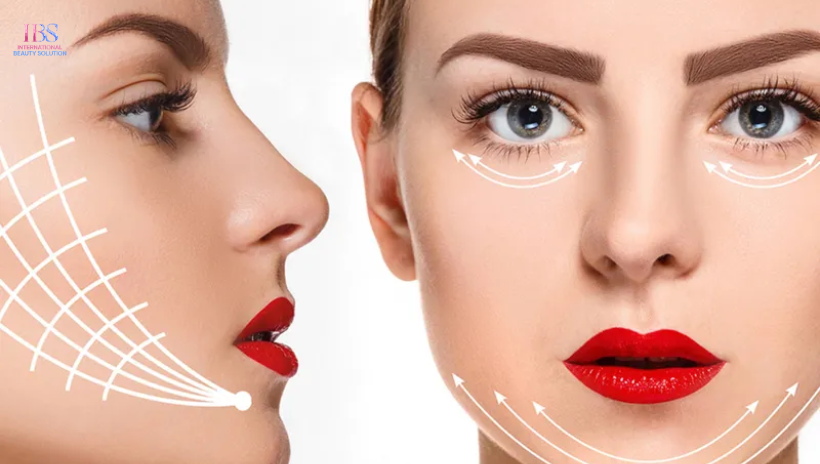 căng chỉ collagen là gì