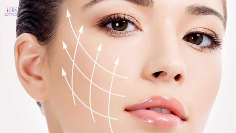 Căng Chỉ Rãnh Cười Là Gì?