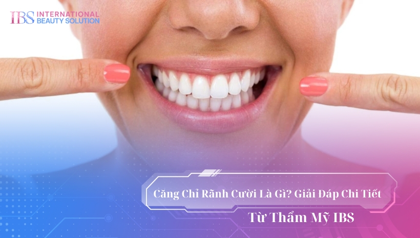 căng chỉ rãnh cười là gì