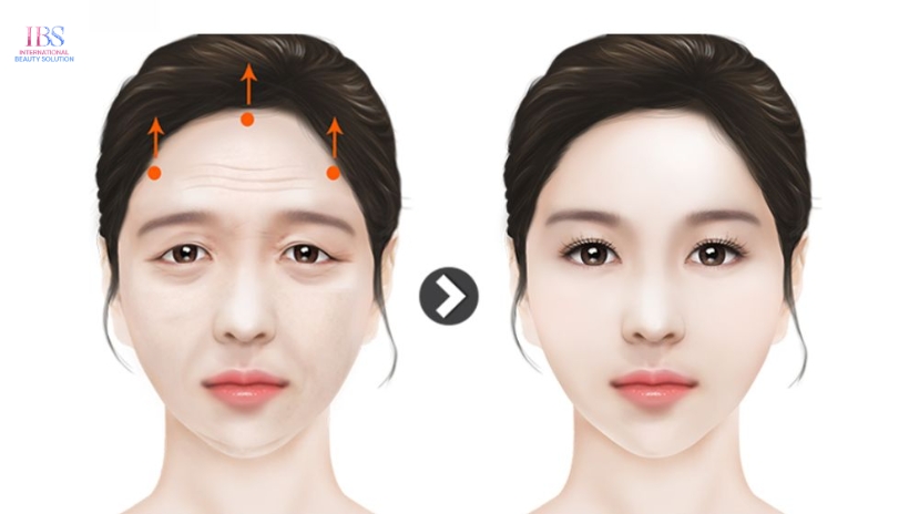 Căng Chỉ Vùng Trán Là Gì?