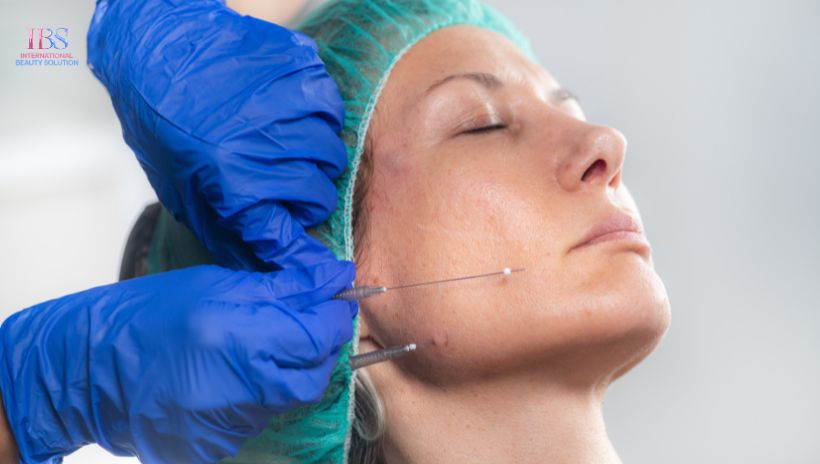 Căng da bằng chỉ collagen