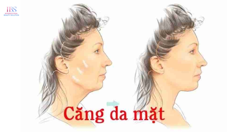 Căng Da Mặt Là Gì? 