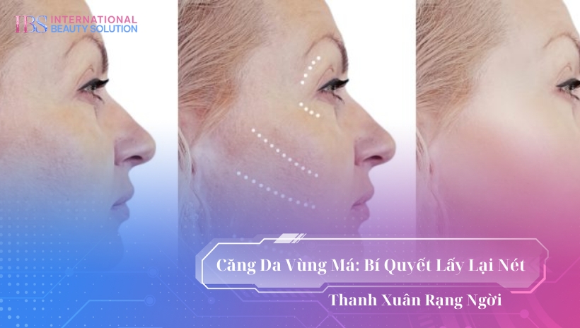 Căng Da Vùng Má Là Gì?