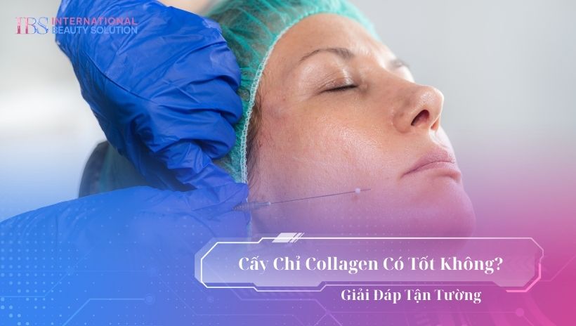 Cấy chỉ collagen có tốt không?