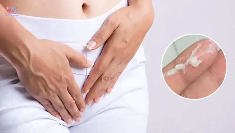 Khí hư màu trắng loãng như nước, ra nhiều bất thường