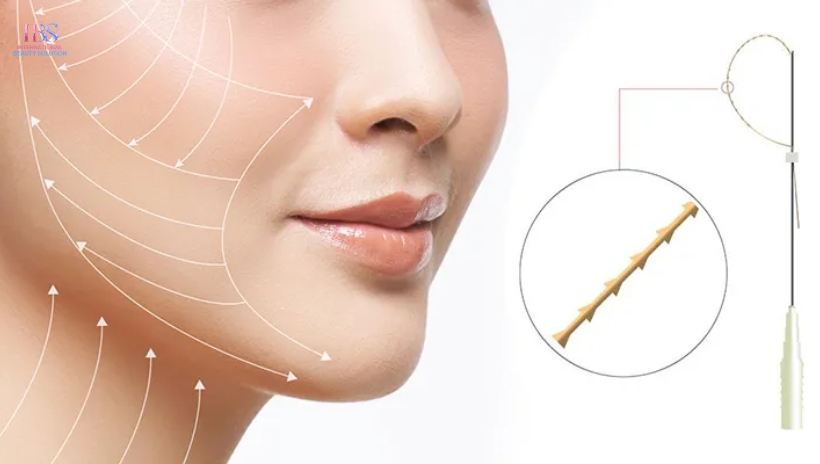 Lợi Ích Của Căng Da Mặt Bằng Chỉ
