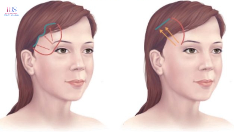 Lợi Ích Của Căng Da Vùng Thái Dương