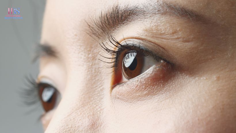 Lưu Ý Quan Trọng Sau Khi Cấy Chỉ Làm Đầy Hốc Mắt