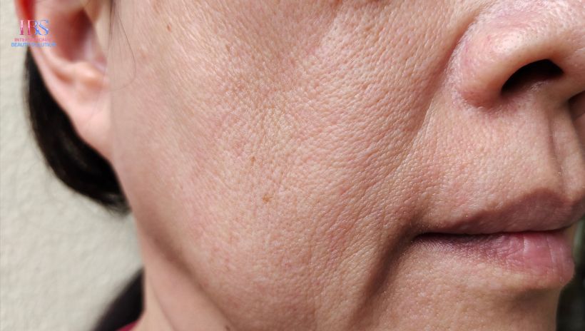 Nếp Nhăn Khoé Miệng (Rãnh Cười) Là Gì Và Tại Sao Xuất Hiện?