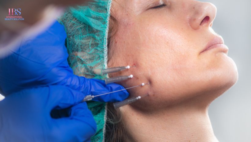 Ưu Điểm Nổi Bật Của Căng Chỉ Collagen