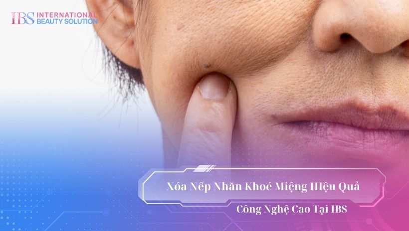 Xoá nếp nhăn khoé miệng