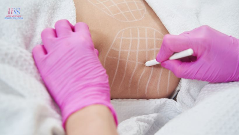 Giải pháp giảm béo chuẩn y khoa tại Viện Thẩm Mỹ IBS