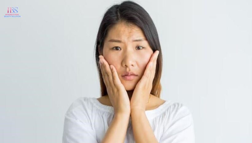 Nỗi ám ảnh mang tên "mỡ mặt"