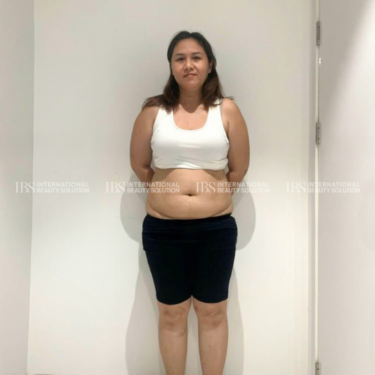 Chị Mỹ Dung trước khi giảm cân tại IBS